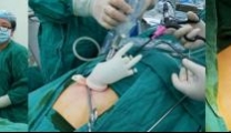 市医院妇科成功实施德阳地区首例自制port单孔腹腔镜手术